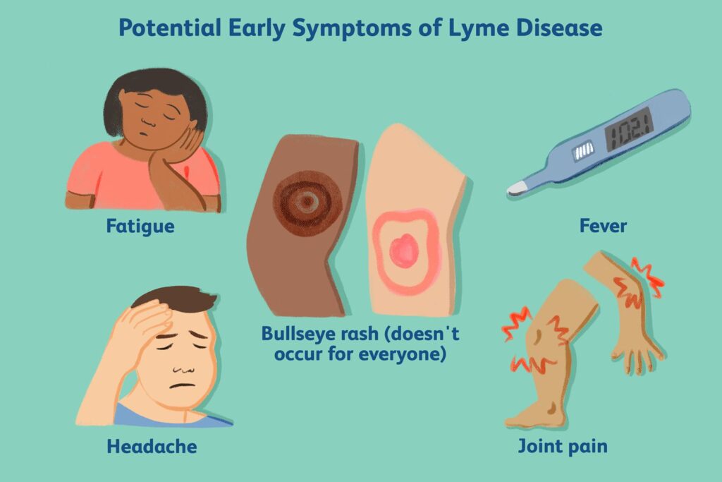 Lyme Disease Rash Early Stage